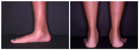 اتصال استخوانهای قوزک پا