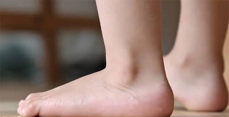 آیا کف پای صاف باید درمان شود؟