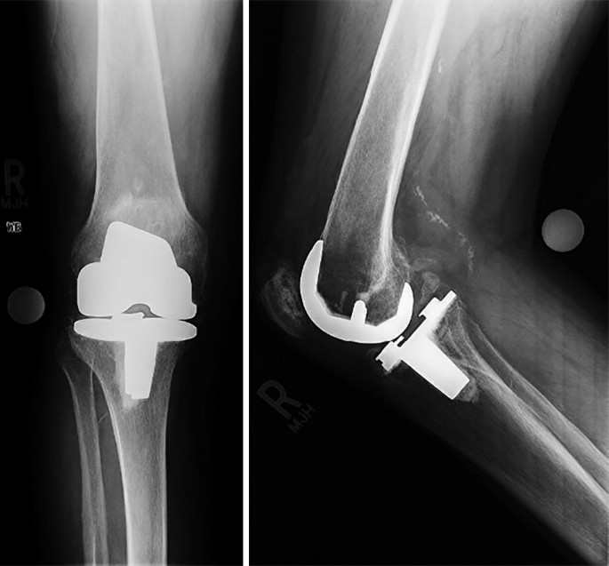 خمیدگی زانو