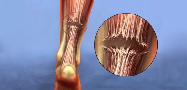 درجه پارگی تاندون آشیل