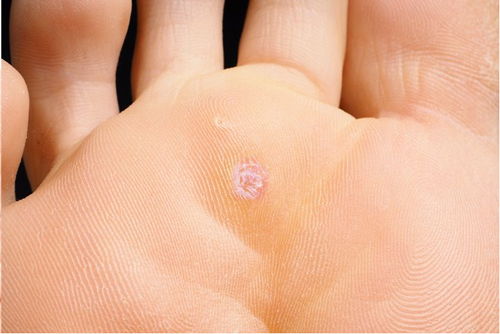 آیا زگیل پا یک بیماری ویروسی است؟