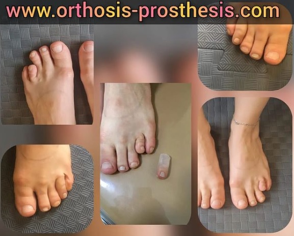 ساخت پروتز دست برای خانمی جوان که در اثر تصادف دچار قطع عضو شدند