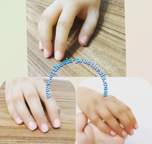 ساخت پروتز دست برای خانمی جوان که در اثر تصادف دچار قطع عضو شدند