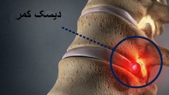 علت دیسک کمر