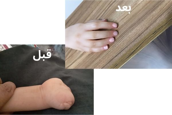 انواع پروتز دست مصنوعی