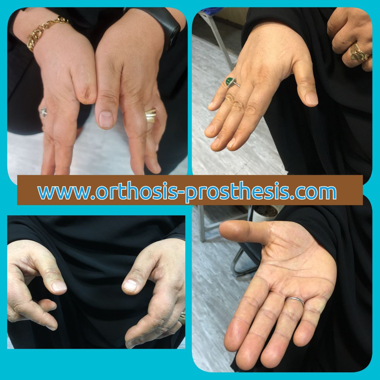 پروتز انگشت شست