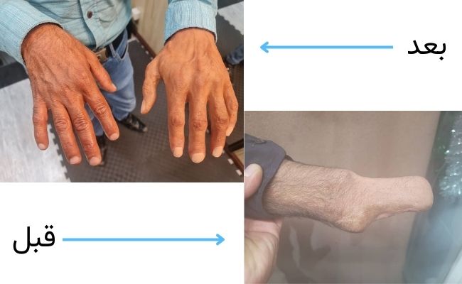 پروتز دست کامل