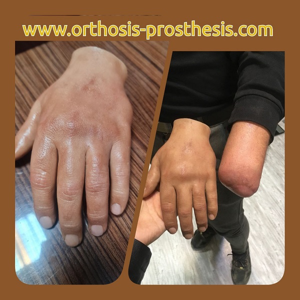 پروتز دست